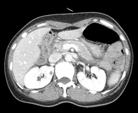 She was a nonsmoker discovered on the opposite side of the superior duodenal an- and nondrinker.