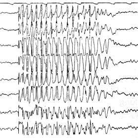 The EEG: normal waves, spikes, and seizures Normal waves: Delta (1-3 Hz); Theta (4-<7 Hz); Alpha 7-12 Hz; Beta (>13 Hz) Spikes may indicate the location of seizures; often seen in interictal period