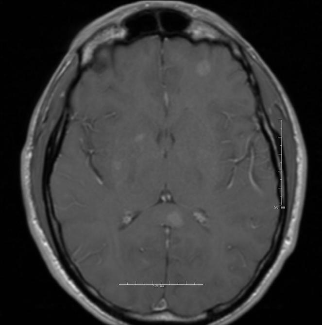 CNS-Only Progression In September 2016 after 10 months on afatinib, patient had a seizure CT scans