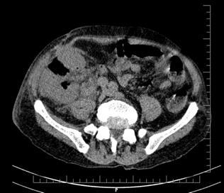 Emphysematous pyelonephritis in transplantation perirenal tissues in right lower quadrant (RLQ) and pelvic area (Figures 1 and 2).