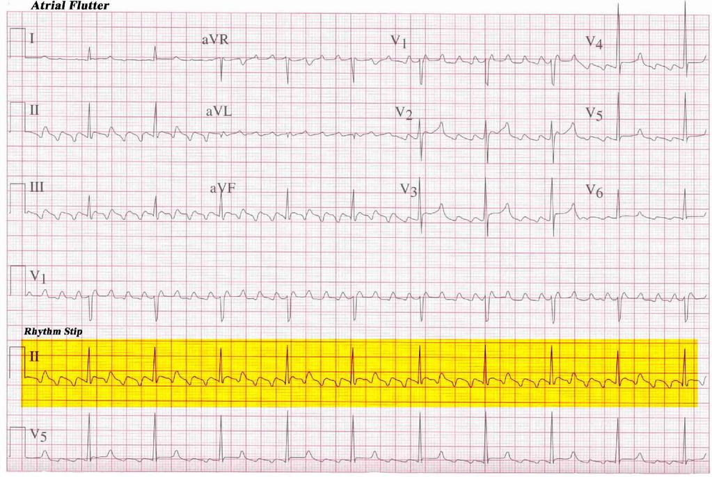 1. Atrial Flutter Rate: Has many atrial contractions for one ventricular contraction. Atrial rate is 250-350 beats/minute. Ventricular is usually between 60-100 beats/minute.