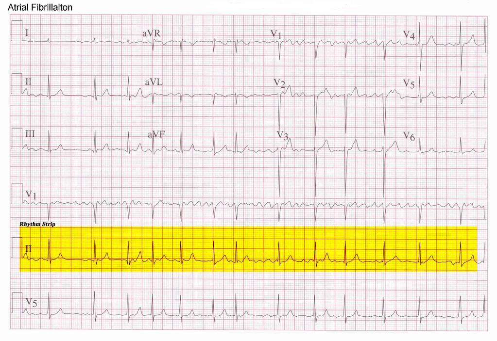 PQRST Information: Has P wave (saw-toothed or flutter waves), QRS complex, but the T wave is not seen because it is covered by the many P waves.