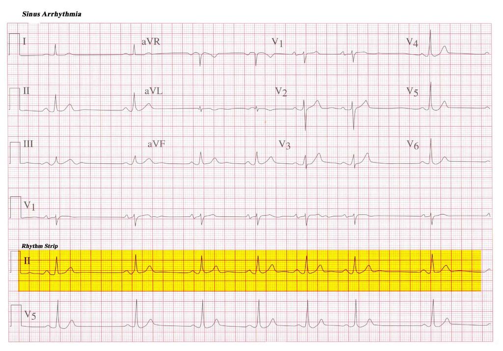 Differential Diagnosis: A variation in sinus rhythm that usually related to respiratory rate and results from increase vagal tone inhibition.