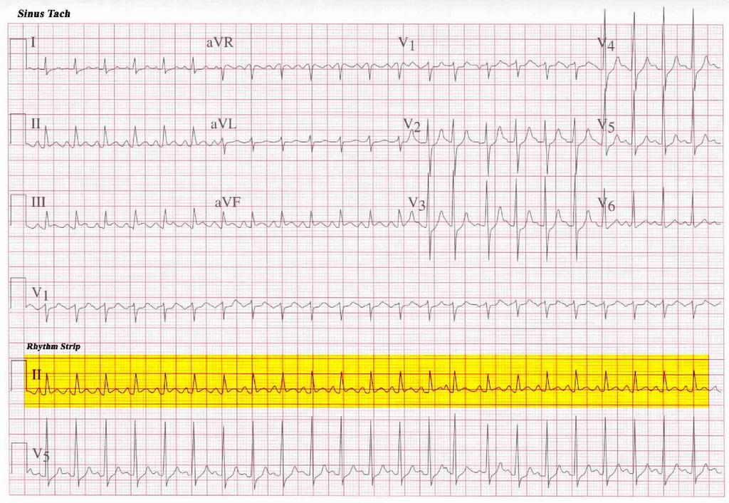 A marked variation in P-P interval may indicate Sick Sinus Syndrome & Wandering Pacemaker.