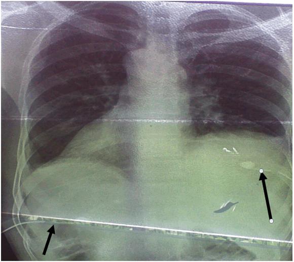 Bâ et al. 825 confirm the diagnosis. The percutaneous drainage still retains its indications especially in large liver abscesses more than 10 cm.