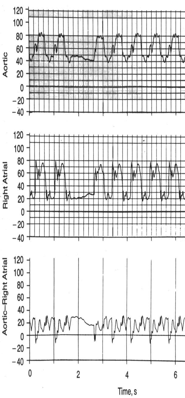 (CorPP) No ROSC (n=76) CorPP 8.4±10 mm Hg Coronary perfusion pressure (CorPP) ROSC (n=24) CorPP 25.6±7.7 mm Hg Paradis NA.