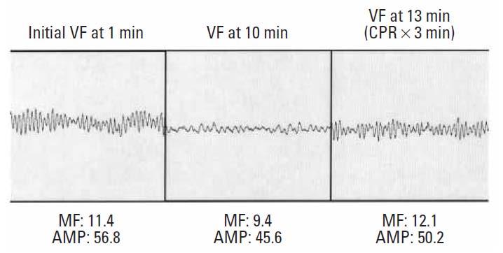 Changes in VF Waveform With and Without 3 Minutes of Pre-shock CPR VF at 10 min (No CPR)