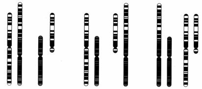 15, 21or 22). (i) The p arms are lost, and the two chromosomes fuse. 21 14 14 21 der(14;21) (ii) Robertsonian translocations are balanced.