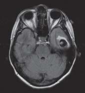 related to the size and location of hematoma Classic presentations Rapid-onset focal neurological