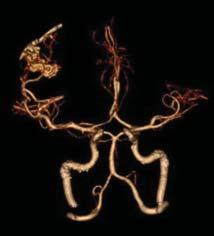 venous thromboses, and vasculitis If suspicious CTA, diagnostic cerebral angiogram is recommended