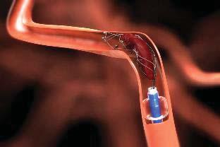 Patients who have contraindications to intravenous r-tpa, endovascular therapy with stent retrievers completed within 6 hours of stroke onset is