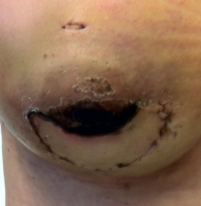 with immediate DIEP flap reconstruction resulting from nippleareola ischemia.