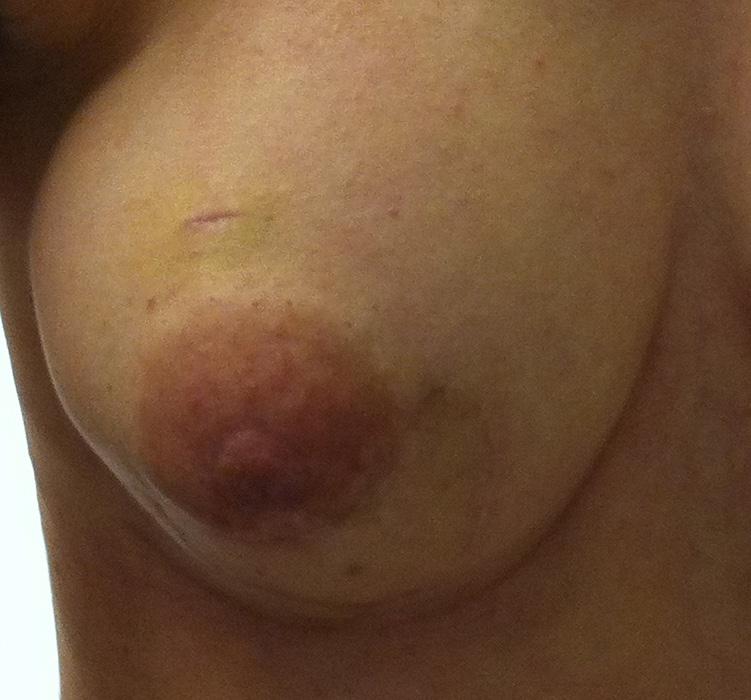 with slight discoloration of lower areola and loss of nipple height.