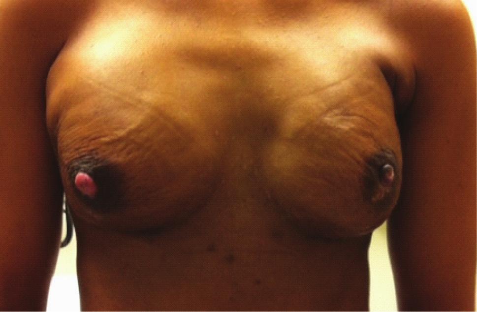 500 Dua et al. Perfusion in nipple-sparing mastectomies Figure 3 Chronic ischemic changes after NSM. Depigmentation occurring after partial ischemia and epidermolysis. NSM, nipplesparing mastectomies.