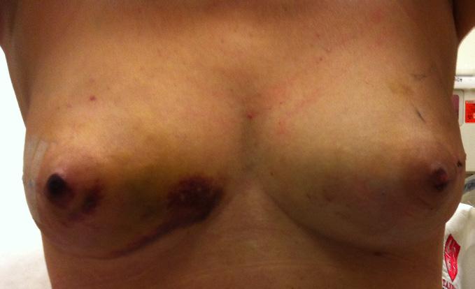 one week later, epidermolysis is apparent in the overlying nipple skin. the delay procedure. A variation on this technique was published by Palmieri and colleagues (33).