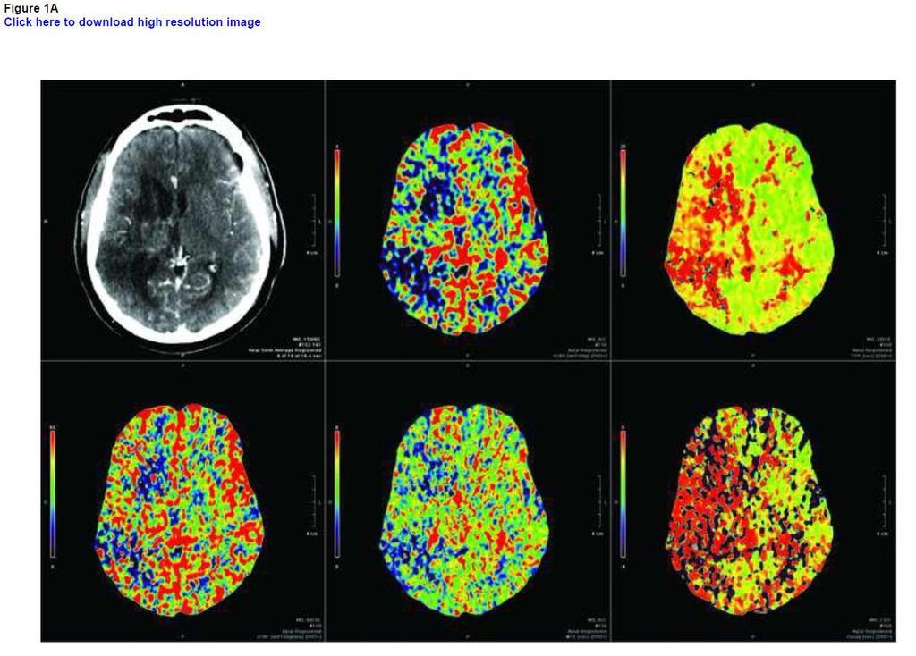 1a. 1b. 1c. 1d. 1e. 1f. Figure 1. Contrast CT image and colorimetric CTP maps of the slice level of the frontoparietal operculum utilized for analyses of Case 1.