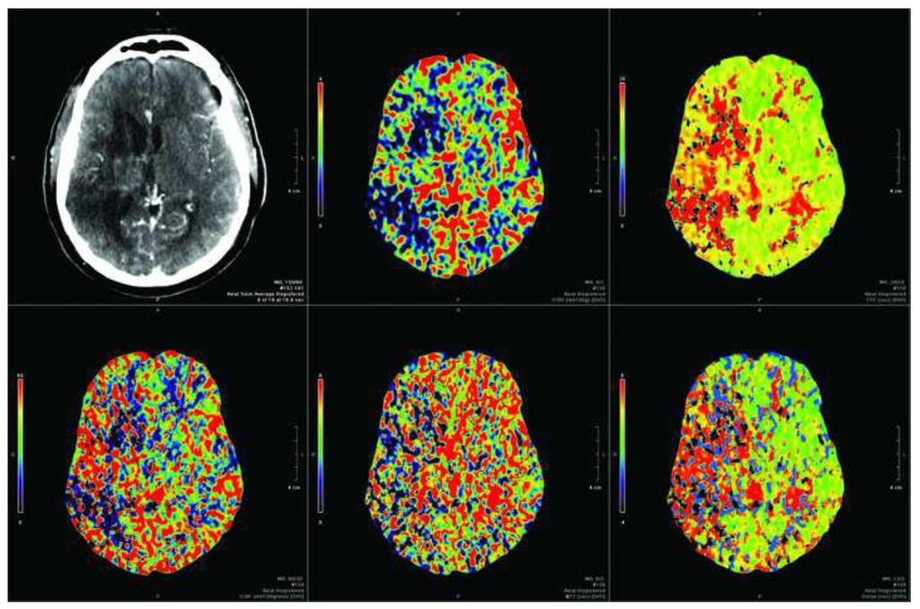 2a. 2b. 2c. 2d. 2e. 2f. Figure 2. Contrast CT image and colorimetric CTP maps of the slice level of the frontoparietal operculum utilized for analyses of Case 1.