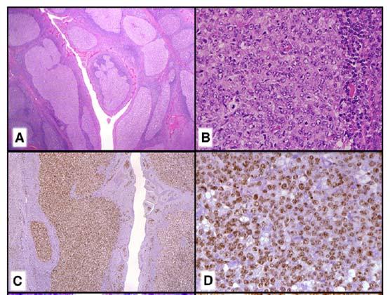 Follicular Lymphoma continued New provisional entity Large B cell lymphoma with IRF4 rearrangement Young adults and children Waldeyer ring/cervical lymph nodes Low stage Resemble FL grade 3B or DLBCL