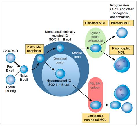 Mantle cell lymphoma (MCL) In situ MCL now in situ mantle cell neoplasia (ISMCN) Two indolent variants Unmutated IGHV SOX11+ MCL Nodal and may progress to classic MCL Mutated IGHV SOX11 MCL