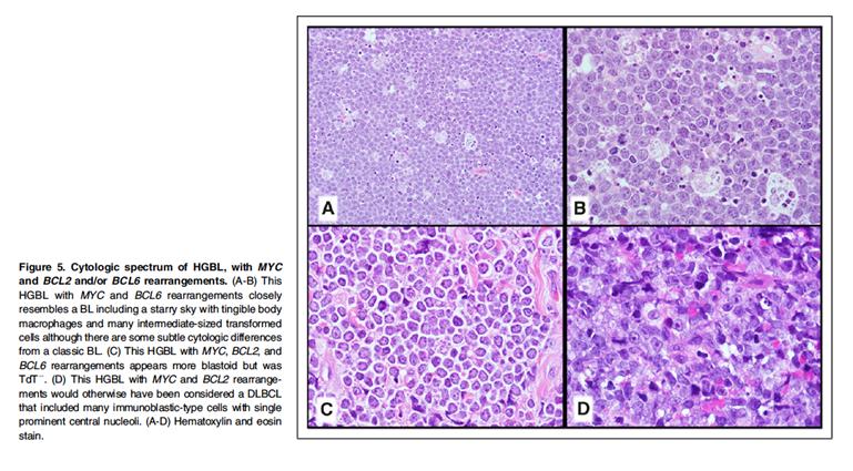 High Grade B cell lymphoma (HGBL) HGBL, NOS Includes previously described entity B cell lymphoma, unclassifiable with features intermediate between DLBCL and BL HGBL with MYC and BCL2 (or BCL6)