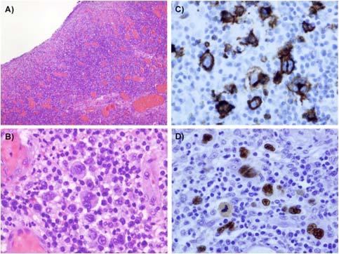 EBV+ DLBCL and EBV+ mucocutaneous ulcer EBV+ DLBCL, NOS Previously included of the elderly Worse prognosis than DLBCL, NOS EBV+ mucocutaneous ulcer, provisional entity Self limited disease,