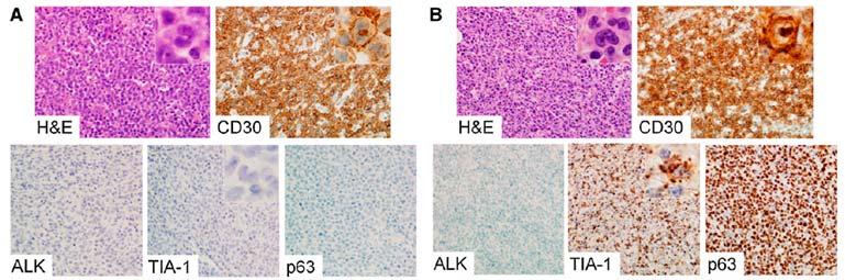 ALK Anaplastic large cell lymphoma No longer provisional entity Require strong and diffuse CD30 positivity Cohesive growth pattern with hallmark type cells DUSP22 rearrangements have better prognosis