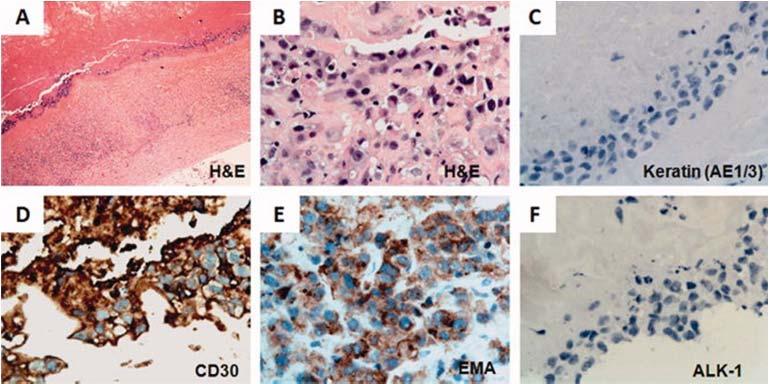 excision Representative cases of genetic subtypes of ALCL. (A) ALK-negative ALCL with DUSP22 rearrangement. The tumor cells are positive for CD30 and are negative for ALK, TIA-1, and p63.