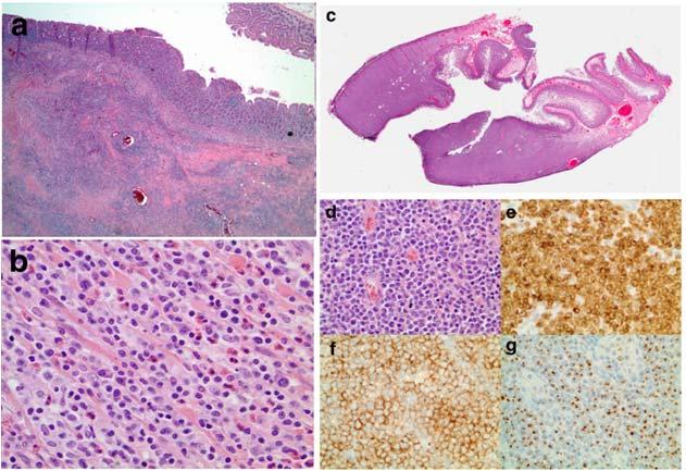 Enteropathy associated T cell lymphoma (EATL) EATL only includes type 1 Type 2 now defined as monomorphic epitheliotropic intestinal TCL (MEITL) shows no association with celiac disease increased in