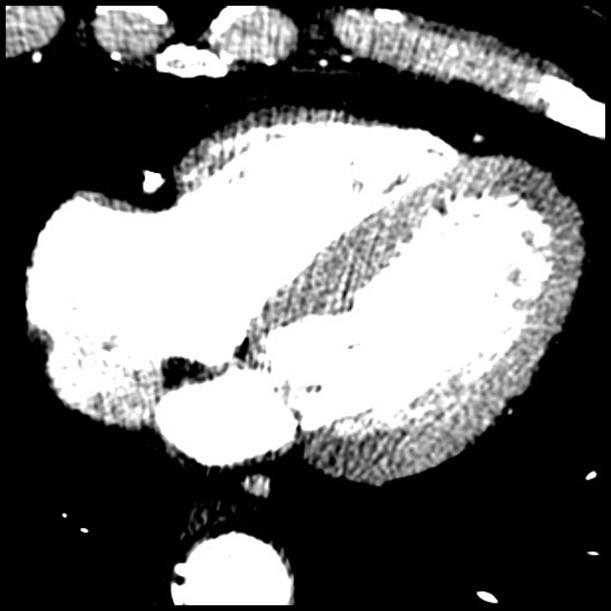 CT Myocardial Perfusion Imaging - Artifacts Beam Hardening (BH) High