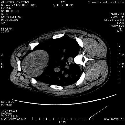 CT Myocardial Perfusion Imaging -