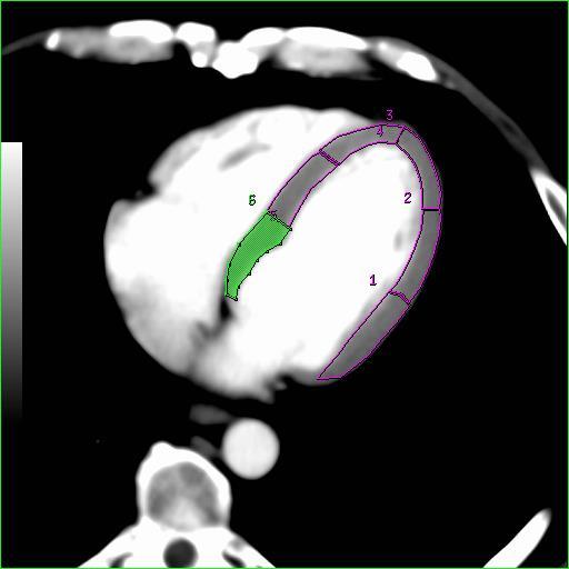 CT Myocardial Perfusion Imaging - Methods Quantitative imaging Prospective ECG gating (mid-diastole)