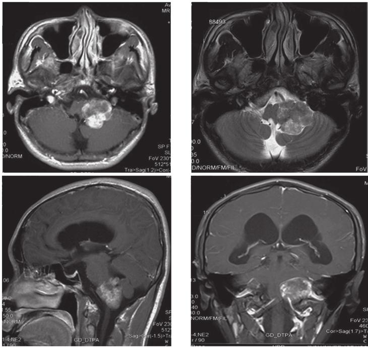 A B C D Figure 2. (A) T1 weighted image and (B) T2 weighted image of pre operative MRI scans of the brain, revealing a round, irregular signal (3.0x2.5x1.0 cm) in the left jugular foramen.
