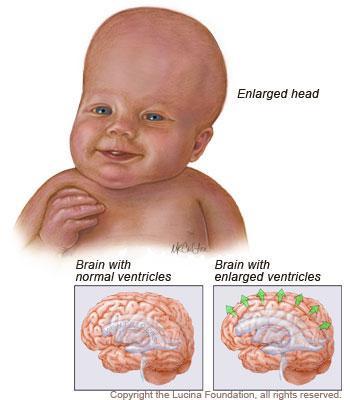 Hydrocephalus: Known as abnormal fluid accumulation in the ventricles of the brain.