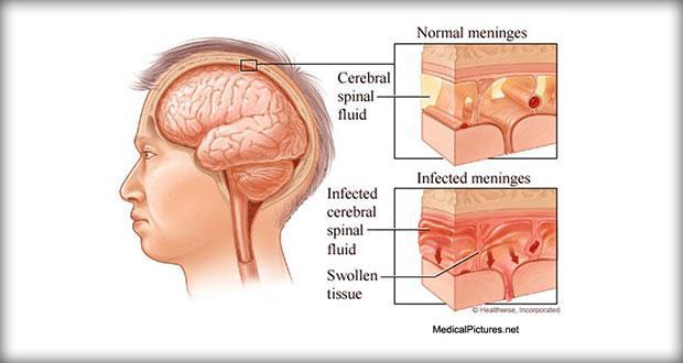 Serious causes of secondary headaches - Meningitis: Inflammation of the tissues that