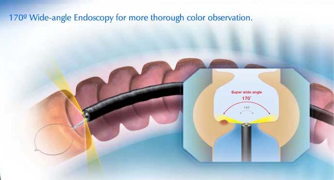 Wide-Angle Colonoscope Older colonoscopes allowed for 140 field of view Current generation colonoscopes: 170 field of view Designed to increase visualization, potentially increasing surface area