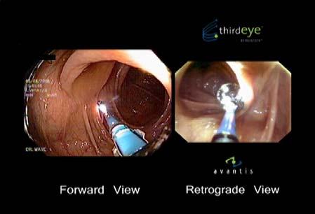 Third-Eye Retroscope Colonoscope s forward view Retroscope View Retrograde view reveals deep pocket-like depressions that are hidden behind folds and are difficult to see even if folds are flattened