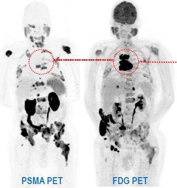 PSMA negative disease appears on FDG PET and not on PSMA PET.