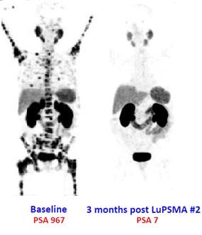 PSMA positive disease not visibly detected from follow-up scan.