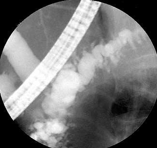 92,93 Figure 6 An endoscopic ultrasound image demonstrating a dilated pancreatic duct (markers) in a patient with advanced chronic pancreatitis.