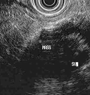Figure 1 An endoscopic ultrasound image of a pancreatic mass in a patient with unexplained acute pancreatitis. The mass is labeled and sits on the splenic vein (SV).