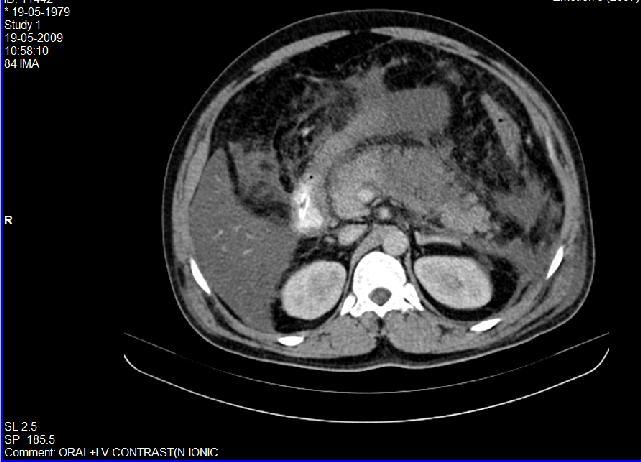 Case No.3 Axial CECT reveals pancreas with irregular margins, enlarged in size with a focal non enhancing area representing necrosis.