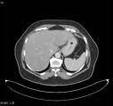 Large intra visceral fat volume, or liver steatosis