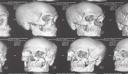 maxillary sinus, hard palate, then posteriorly through alveolar process of maxilla into the