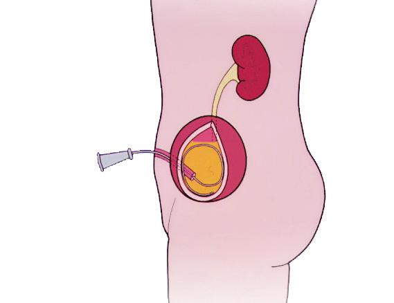 12 Kidneys Catheter Diagram 5: The catheter is inserted into the pouch The most common complications which may occur are: Urine infections (20 per cent) Mucus build up (which may cause stones to