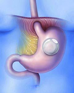 Intragastric Balloons Recently Approved by FDA for BMI 30-40 with NO comorbidities Either swallowed or placed endoscopically.