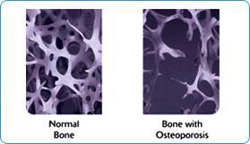 Osteoporosis: Defining the Problem A skeletal disorder characterized by compromised bone strength