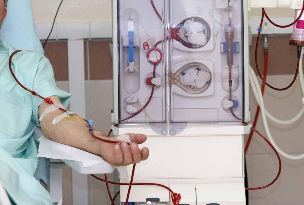 Dialysis is the treatment for kidney failure. It is the medical word for filtering waste products and removing excess fluid from the blood via an artificial kidney.