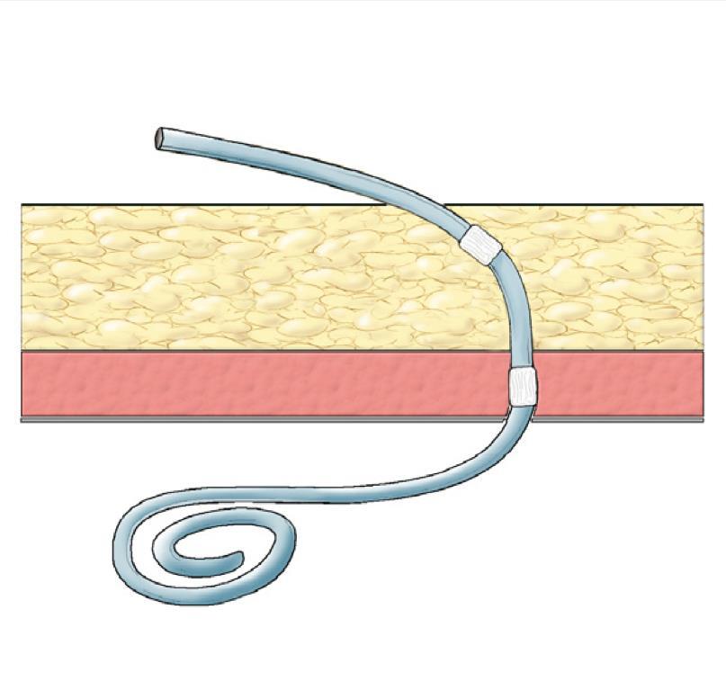 PD catheter External Segment Exit site > 4 cm 2 nd cuff subcutaneous tissue Tunneled