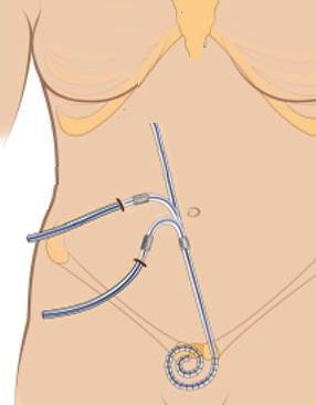 IRPCPD study: 503 PD catheters Orientation of the exit site: upward 13% lateral 24% downward 46% arcuate configuration No difference in