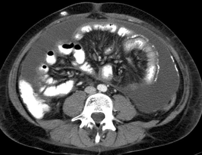 Ascites Thickened peritoneum Calcifications Bowel loops are drawn